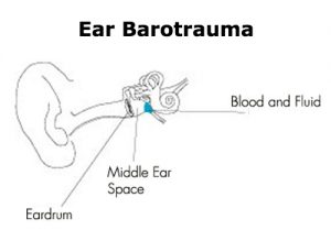 Ear Barotrauma
