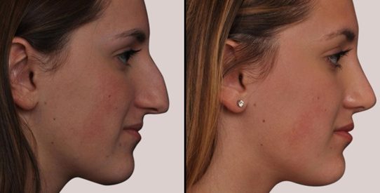 How to Get Rid of the Swelling Face After a Rhinoplasty Surgery