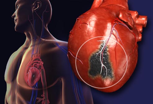 Major Risk Factors And Prevention Of Heart Attacks