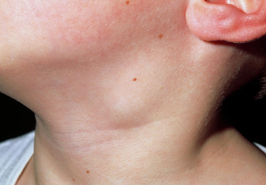 swollen neck lymph nodes back of neck