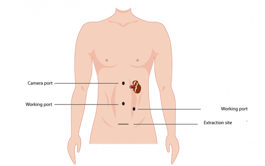 Nephrectomy: Laparoscopic kidney removal vs. open incision