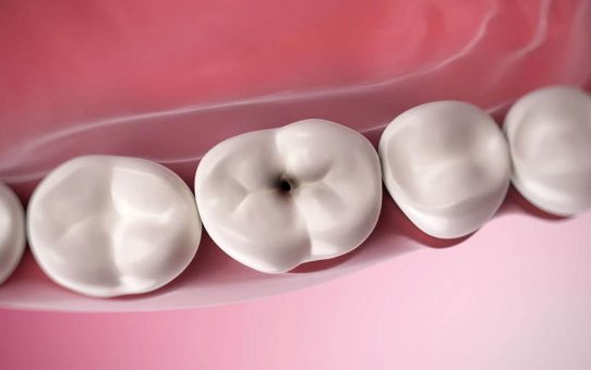 Looking for cavities treatment? Here it is