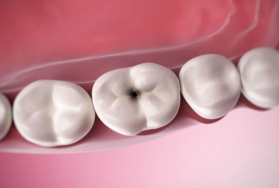 Looking for cavities treatment Here it is Smile Delivery Online