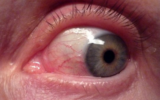 Red Spots in Eyes: Causes and Treatment