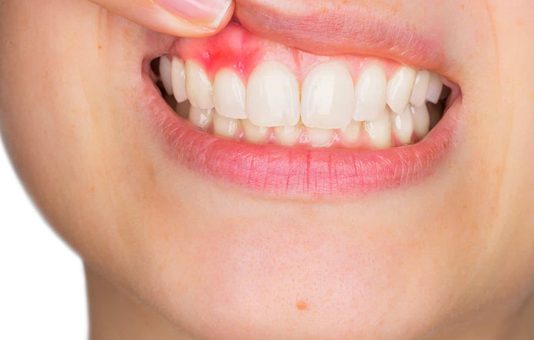 Home Remedies For Gum Disease