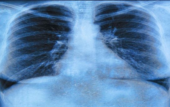 Lungs Infection: Causes, Symptoms and Ways to Avoid