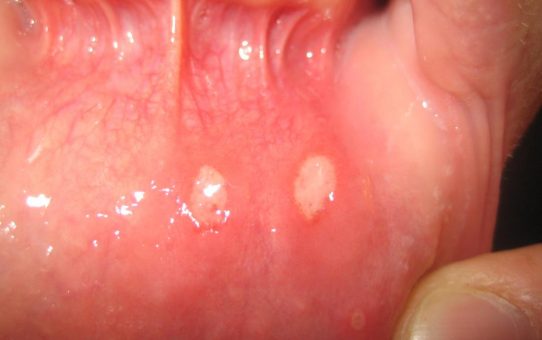 What is Mouth Rot? Symptoms of the Contagious Disease?