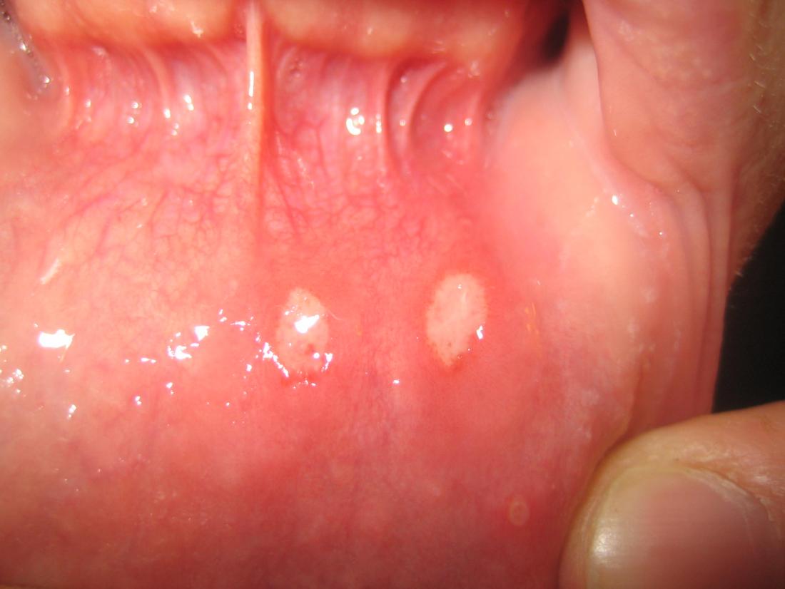 mouth-ulcer-lower-lip
