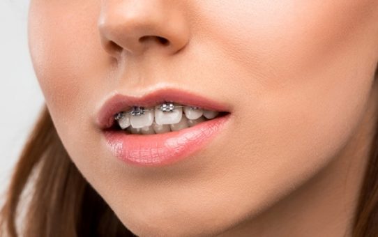 How to Fix Overbite With Overbite Braces & Other Treatments?
