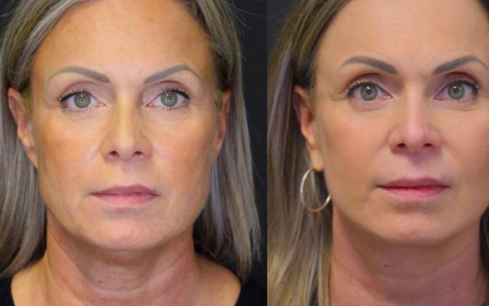 Facelift without Surgery – SMAS-lifting and Its Benefits