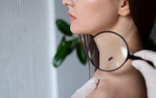 How Long Can I Have Skin Cancer Without Knowing?