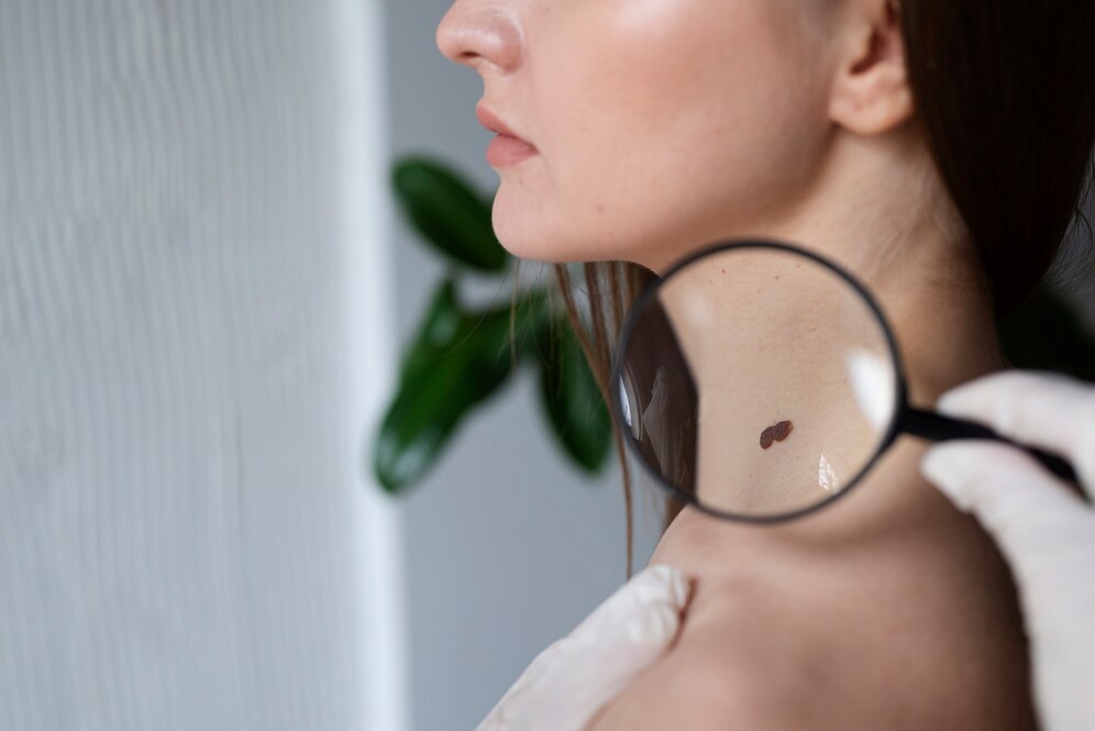 skin cancer marks on neck of girl